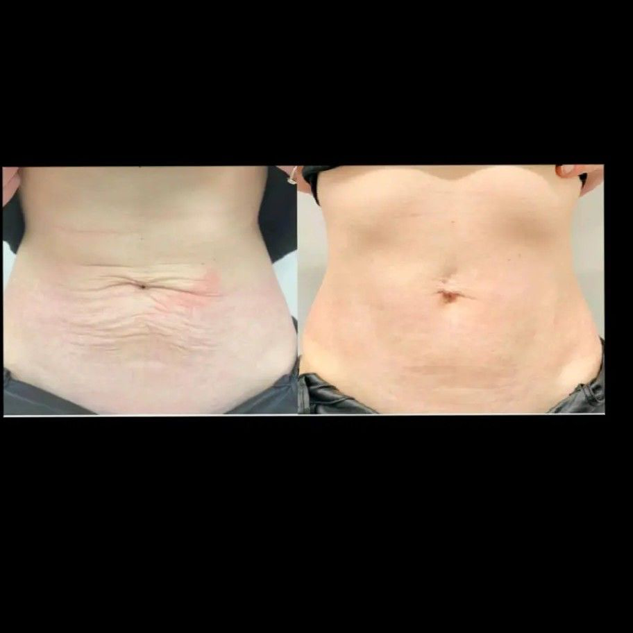 client 3d dermaforce treatment results